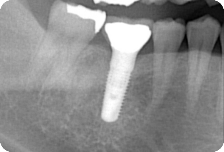 インプラントのレントゲン画像