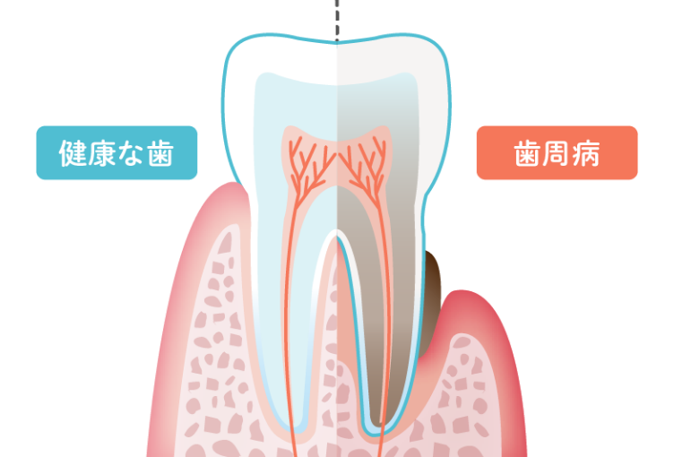 歯周再生療法のイメージイラスト