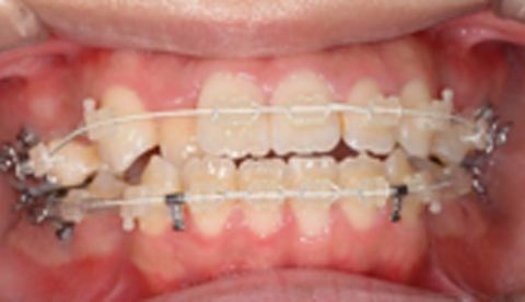 成人矯正治療における治療経過 治療前1
