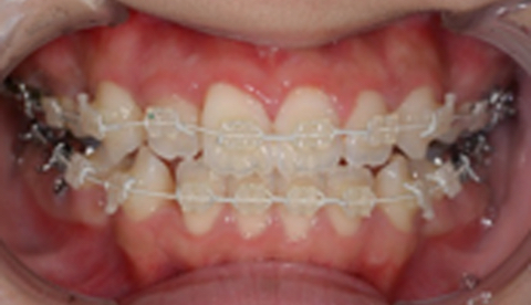 成人矯正治療における治療経過 治療開始6ヶ月1