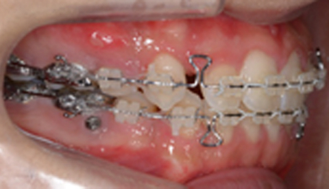 成人矯正治療における治療経過 治療開始10ヶ月2
