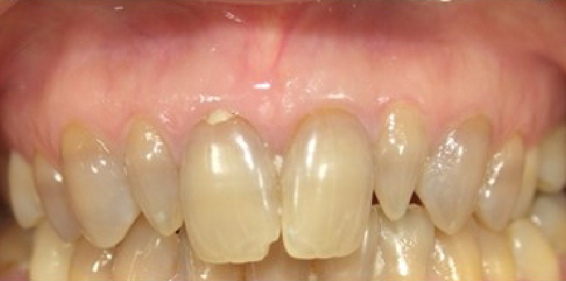 歯のすり減りのM.I.治療の例 治療前