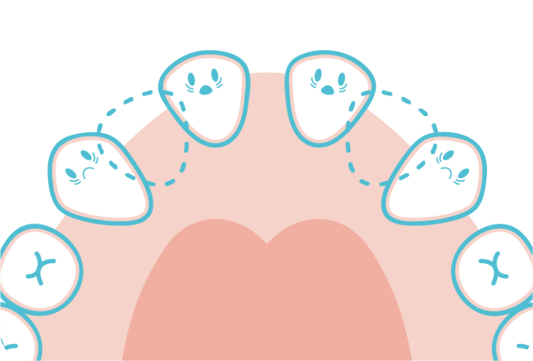 永久歯の先天性欠損のイメージイラスト