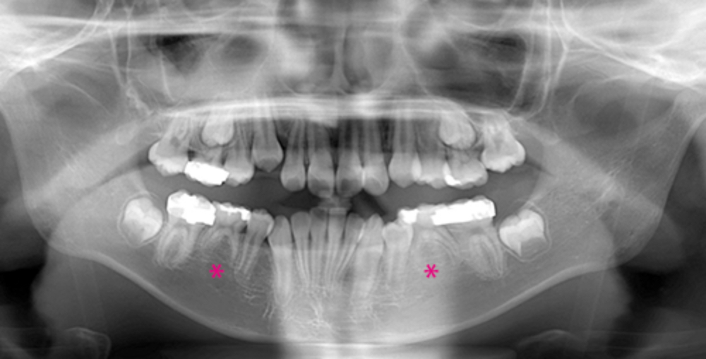 下顎左右第二小臼歯先天性欠損　治療対応前の図