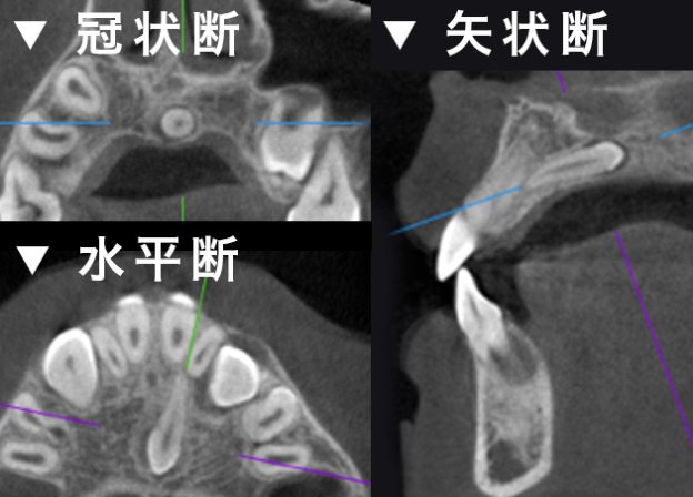 過剰歯の診査 冠状断 水平断 矢状断