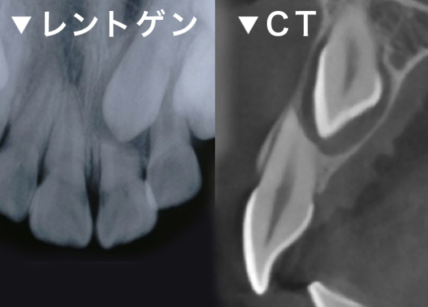 埋伏歯の診査 レントゲン CT