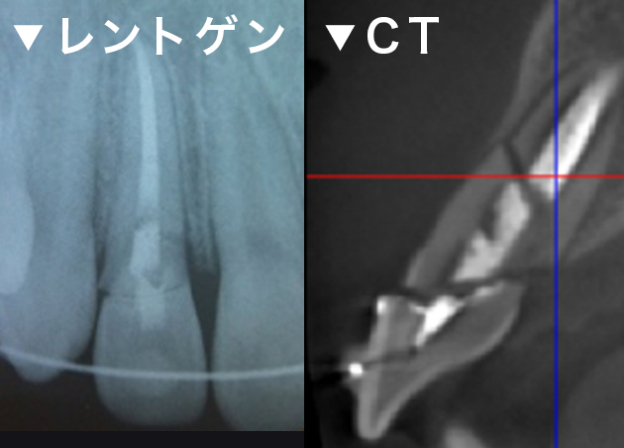 歯の外傷時の診査 レントゲン CT