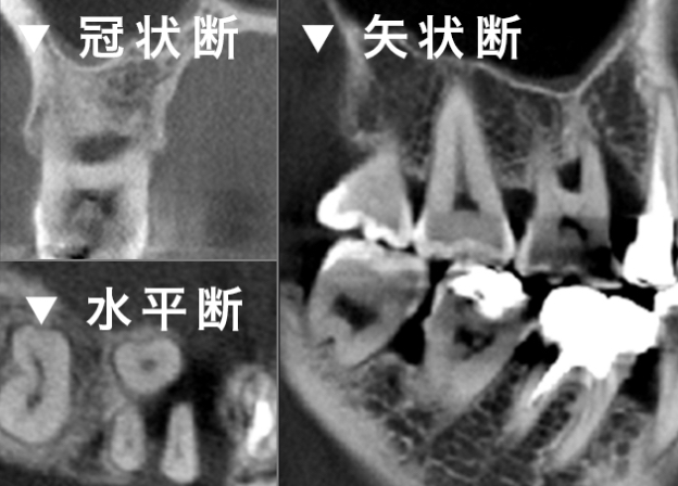 歯周病の診査 冠状断 水平断 矢状断