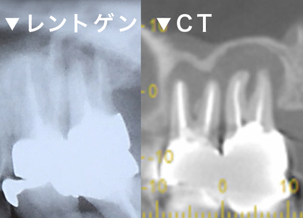 根管治療時の診査 レントゲン CT