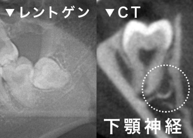 親しらずの抜歯前の診査 レントゲン CT