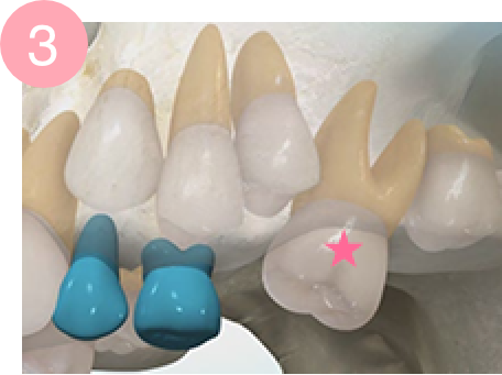 上顎第一大臼歯の異所萌出を放置した症状の例 3
