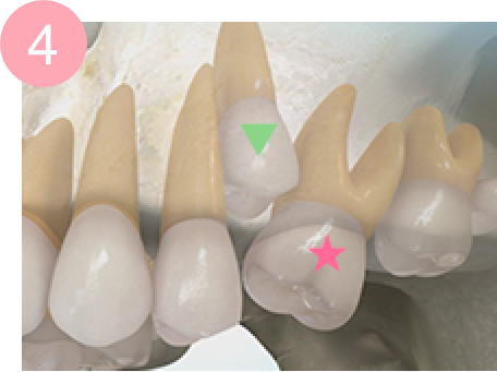 上顎第一大臼歯の異所萌出を放置した症状の例 4