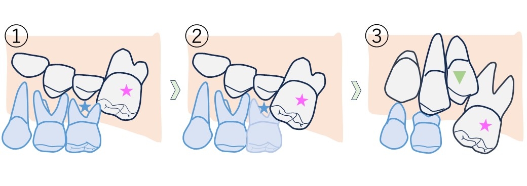 上顎第一大臼歯の異所萌出を放置した症状の例