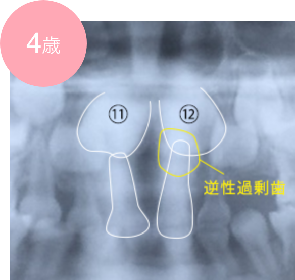 過剰歯による永久歯萌出スペースの不足の例 4歳