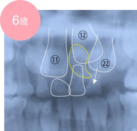 過剰歯による永久歯萌出スペースの不足の例 6歳