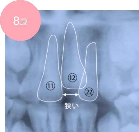 過剰歯による永久歯萌出スペースの不足の例 8歳