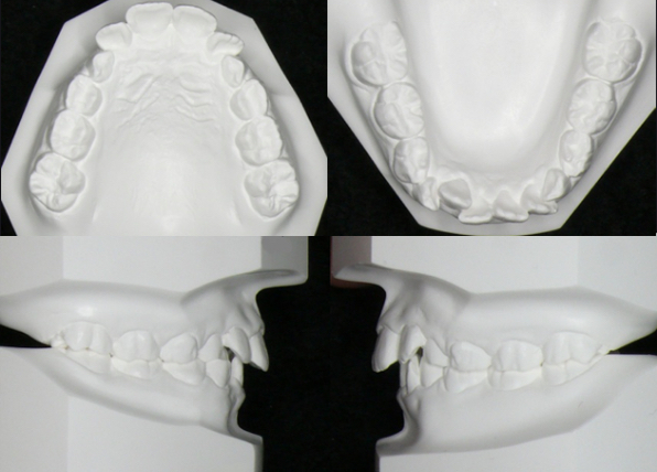 歯列模型