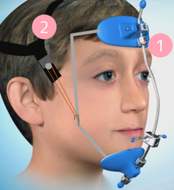 上顎前方牽引装置による受け口（反対咬合）の治療の図
