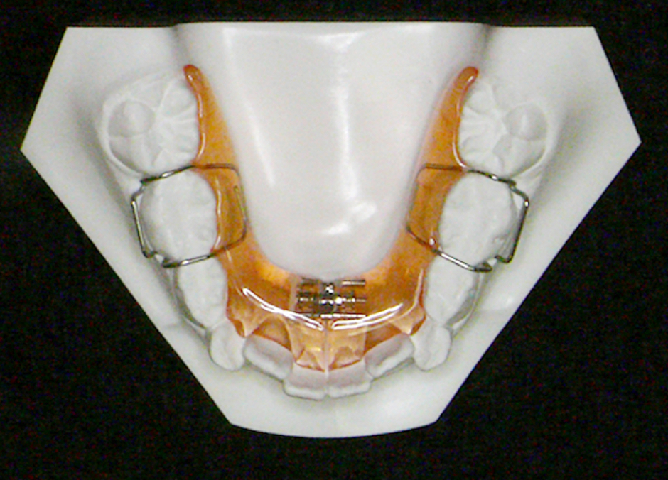 下顎歯列拡大装置（取り外し式）の図