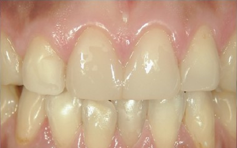 歯のすり減りのM.I.治療の例 治療後