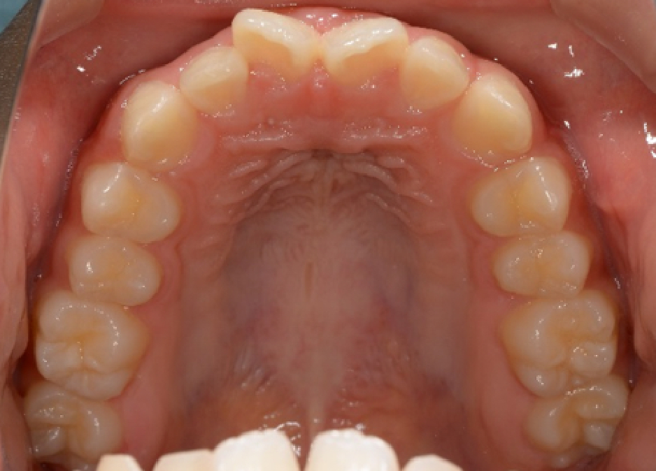 上の前歯の歪みの図2