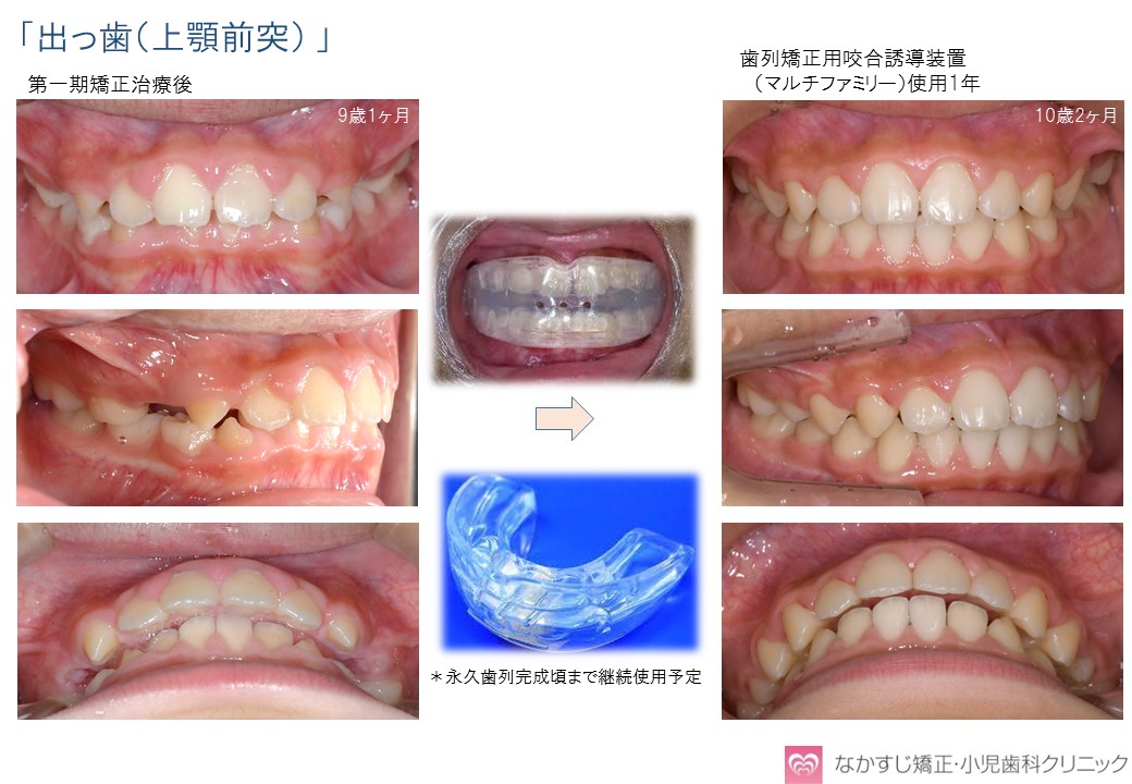 子どものマウスピース矯正について 大阪豊中市の歯科矯正治療 なかすじ矯正 小児歯科クリニック