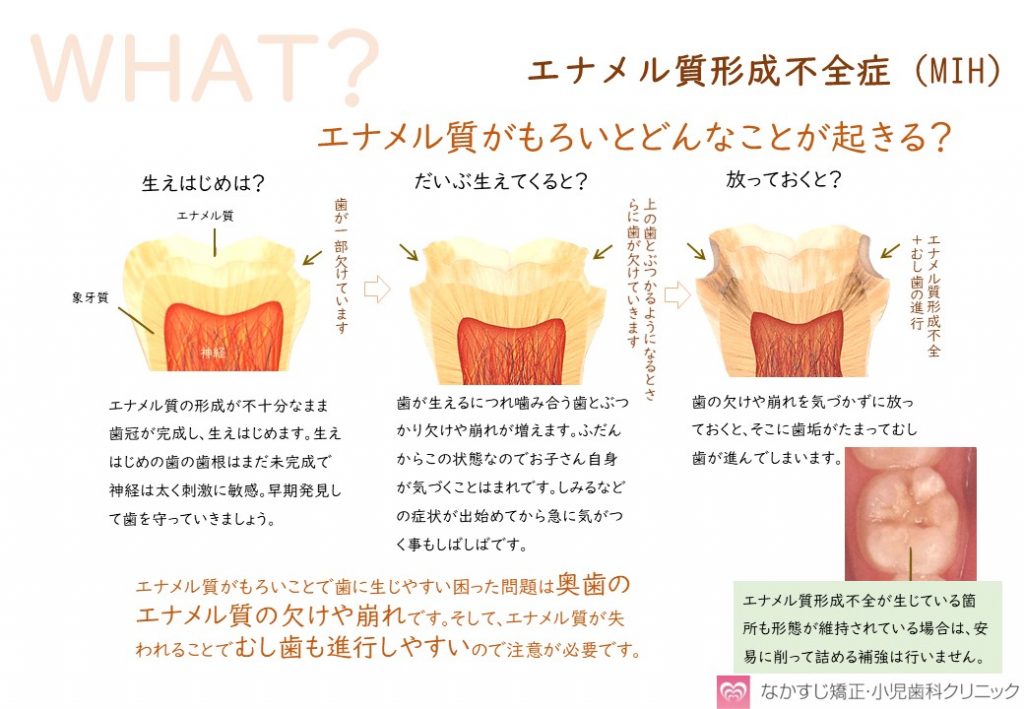 エナメル質形成不全