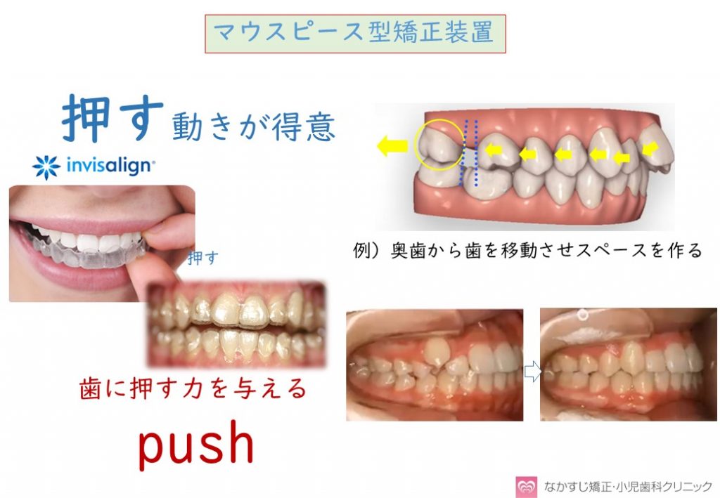 マウスピース装置の特徴について