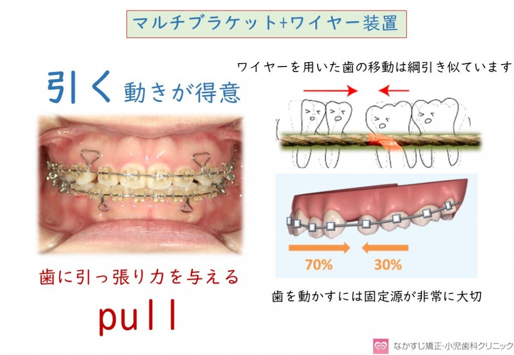 ブラケット+ワイヤー装置の特徴について