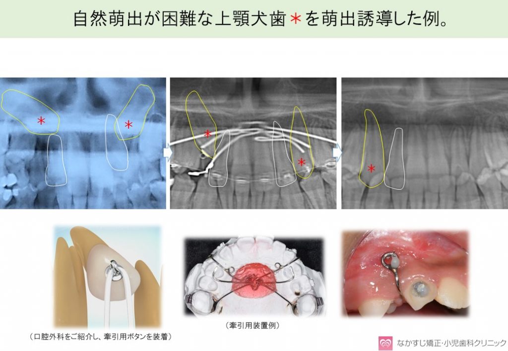 上顎犬歯萌出誘導