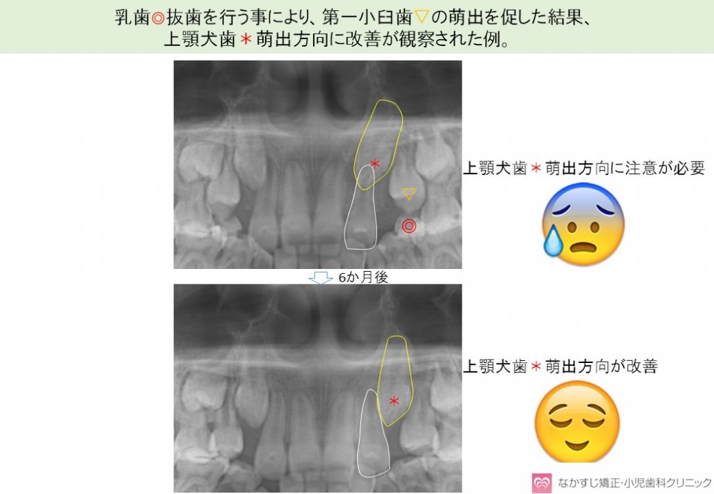 乳歯抜歯による上顎犬歯の萌出促進